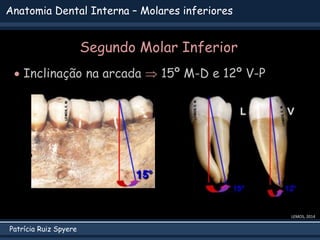 Patrícia Ruiz Spyere
Anatomia Dental Interna – Molares inferiores
 Inclinação na arcada  15º M-D e 12º V-P
LEMOS, 2014
Segundo Molar Inferior
 