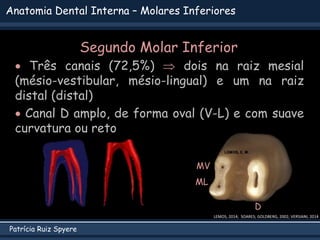 Patrícia Ruiz Spyere
Anatomia Dental Interna – Molares Inferiores
 Três canais (72,5%)  dois na raiz mesial
(mésio-vestibular, mésio-lingual) e um na raiz
distal (distal)
 Canal D amplo, de forma oval (V-L) e com suave
curvatura ou reto
LEMOS, 2014; SOARES; GOLDBERG, 2002; VERSIANI, 2014
MV
ML
D
Segundo Molar Inferior
 