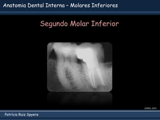 Patrícia Ruiz Spyere
Anatomia Dental Interna – Molares Inferiores
LEMOS, 2014
Segundo Molar Inferior
 