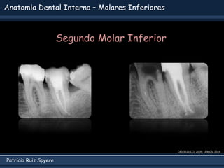 Patrícia Ruiz Spyere
Anatomia Dental Interna – Molares Inferiores
CASTELLUCCI, 2009; LEMOS, 2014
Segundo Molar Inferior
 
