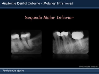 Patrícia Ruiz Spyere
Anatomia Dental Interna – Molares Inferiores
CASTELLUCCI, 2009; LEMOS, 2014
Segundo Molar Inferior
 
