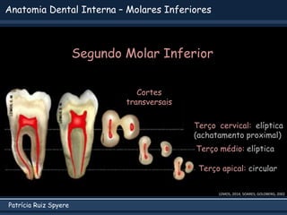 Patrícia Ruiz Spyere
LEMOS, 2014; SOARES; GOLDBERG, 2002
Cortes
transversais
Anatomia Dental Interna – Molares Inferiores
Terço cervical: elíptica
(achatamento proximal)
Terço médio: elíptica
Terço apical: circular
Segundo Molar Inferior
 