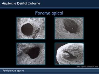 Patrícia Ruiz Spyere
Anatomia Dental Interna
Forame apical
LOPES; SIQUEIRA JUNIOR; ELIAS, 2010;
 