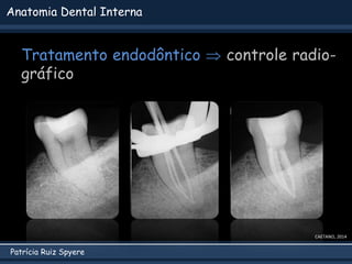 Patrícia Ruiz Spyere
Anatomia Dental Interna
Tratamento endodôntico  controle radio-
gráfico
CAETANO, 2014
 