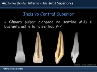 Patrícia Ruiz Spyere
Anatomia Dental Interna – Incisivos Superiores
Incisivo Central Superior
 Câmara pulpar alargada no sentido M-D e
bastante estreita no sentido V-P
LEMOS, 2014; SOARES; GOLDBERG, 2002
 