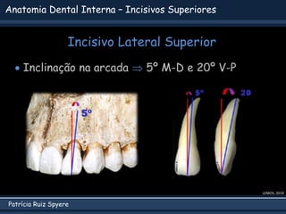 Patrícia Ruiz Spyere
Anatomia Dental Interna – Incisivos Superiores
 Inclinação na arcada  5º M-D e 20º V-P
LEMOS, 2014
Incisivo Lateral Superior
 