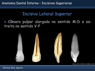Patrícia Ruiz Spyere
Anatomia Dental Interna – Incisivos Superiores
 Câmara pulpar alargada no sentido M-D e es-
treita no sentido V-P
LEMOS, 2014; SOARES; GOLDBERG, 2002
Incisivo Lateral Superior
 
