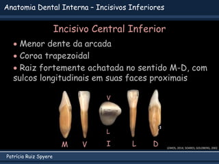 Patrícia Ruiz Spyere
Anatomia Dental Interna – Incisivos Inferiores
Incisivo Central Inferior
 Menor dente da arcada
 Coroa trapezoidal
 Raiz fortemente achatada no sentido M-D, com
sulcos longitudinais em suas faces proximais
LEMOS, 2014; SOARES; GOLDBERG, 2002
V L D
M I
V
L
 