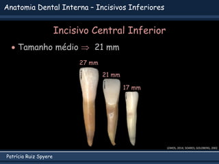 Patrícia Ruiz Spyere
Anatomia Dental Interna – Incisivos Inferiores
LEMOS, 2014; SOARES; GOLDBERG, 2002
Incisivo Central Inferior
 Tamanho médio  21 mm
21 mm
27 mm
17 mm
 