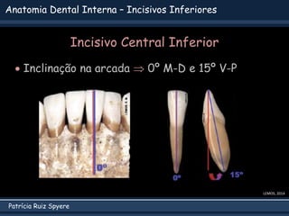 Patrícia Ruiz Spyere
Anatomia Dental Interna – Incisivos Inferiores
LEMOS, 2014
Incisivo Central Inferior
 Inclinação na arcada  0º M-D e 15º V-P
 
