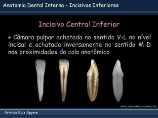 Patrícia Ruiz Spyere
Anatomia Dental Interna – Incisivos Inferiores
LEMOS, 2014; SOARES; GOLDBERG, 2002
Incisivo Central Inferior
 Câmara pulpar achatada no sentido V-L no nível
incisal e achatada inversamente no sentido M-D
nas proximidades do colo anatômico
 