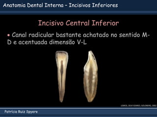 Patrícia Ruiz Spyere
Anatomia Dental Interna – Incisivos Inferiores
 Canal radicular bastante achatado no sentido M-
D e acentuada dimensão V-L
LEMOS, 2014 SOARES; GOLDBERG, 2002
Incisivo Central Inferior
 