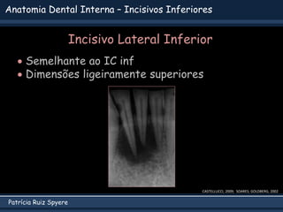 Patrícia Ruiz Spyere
Anatomia Dental Interna – Incisivos Inferiores
Incisivo Lateral Inferior
 Semelhante ao IC inf
 Dimensões ligeiramente superiores
CASTELLUCCI, 2009; SOARES; GOLDBERG, 2002
 