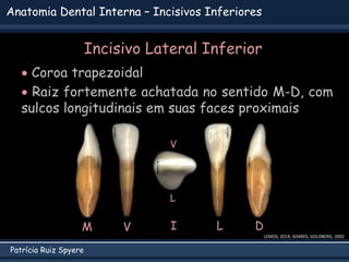 Patrícia Ruiz Spyere
Anatomia Dental Interna – Incisivos Inferiores
Incisivo Lateral Inferior
 Coroa trapezoidal
 Raiz fortemente achatada no sentido M-D, com
sulcos longitudinais em suas faces proximais
LEMOS, 2014; SOARES; GOLDBERG, 2002
V L D
M I
V
L
 