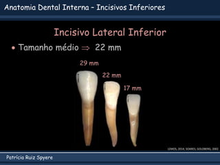 Patrícia Ruiz Spyere
Anatomia Dental Interna – Incisivos Inferiores
LEMOS, 2014; SOARES; GOLDBERG, 2002
Incisivo Lateral Inferior
 Tamanho médio  22 mm
22 mm
29 mm
17 mm
 