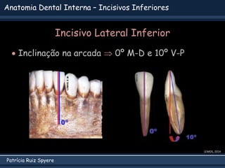 Patrícia Ruiz Spyere
Anatomia Dental Interna – Incisivos Inferiores
LEMOS, 2014
Incisivo Lateral Inferior
 Inclinação na arcada  0º M-D e 10º V-P
 