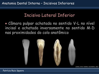 Patrícia Ruiz Spyere
Anatomia Dental Interna – Incisivos Inferiores
LEMOS, 2014; SOARES; GOLDBERG, 2002
Incisivo Lateral Inferior
 Câmara pulpar achatada no sentido V-L no nível
incisal e achatada inversamente no sentido M-D
nas proximidades do colo anatômico
 