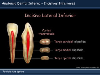 Patrícia Ruiz Spyere
Anatomia Dental Interna – Incisivos Inferiores
LEMOS, 2014; SOARES; GOLDBERG, 2002
Incisivo Lateral Inferior
Cortes
transversais
Terço apical: elipsóide
Terço médio: elipsóide
Terço cervical: elipsóide
 