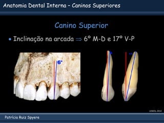 Patrícia Ruiz Spyere
Anatomia Dental Interna – Caninos Superiores
Canino Superior
LEMOS, 2014
 Inclinação na arcada  6º M-D e 17º V-P
 
