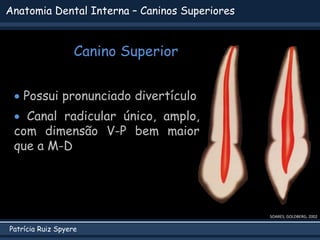 Patrícia Ruiz Spyere
Anatomia Dental Interna – Caninos Superiores
Canino Superior
SOARES; GOLDBERG, 2002
 Possui pronunciado divertículo
 Canal radicular único, amplo,
com dimensão V-P bem maior
que a M-D
 