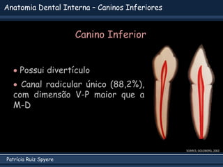 Patrícia Ruiz Spyere
Anatomia Dental Interna – Caninos Inferiores
Canino Inferior
 Possui divertículo
 Canal radicular único (88,2%),
com dimensão V-P maior que a
M-D
SOARES; GOLDBERG, 2002
 