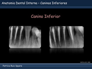 Patrícia Ruiz Spyere
Anatomia Dental Interna – Caninos Inferiores
Canino Inferior
CASTELLUCCI, 2009
 