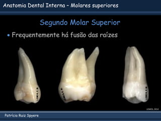 Patrícia Ruiz Spyere
Anatomia Dental Interna – Molares superiores
Segundo Molar Superior
 Frequentemente há fusão das raí...