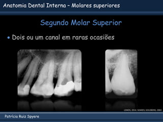 Patrícia Ruiz Spyere
Anatomia Dental Interna – Molares superiores
Segundo Molar Superior
 Dois ou um canal em raras ocasi...