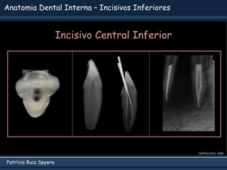 Patrícia Ruiz Spyere
Anatomia Dental Interna – Incisivos Inferiores
CASTELLUCCI, 2009
Incisivo Central Inferior
 