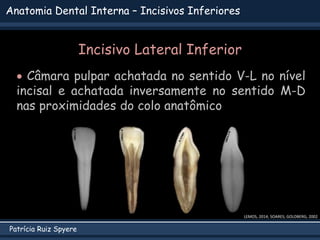 Patrícia Ruiz Spyere
Anatomia Dental Interna – Incisivos Inferiores
LEMOS, 2014; SOARES; GOLDBERG, 2002
Incisivo Lateral I...
