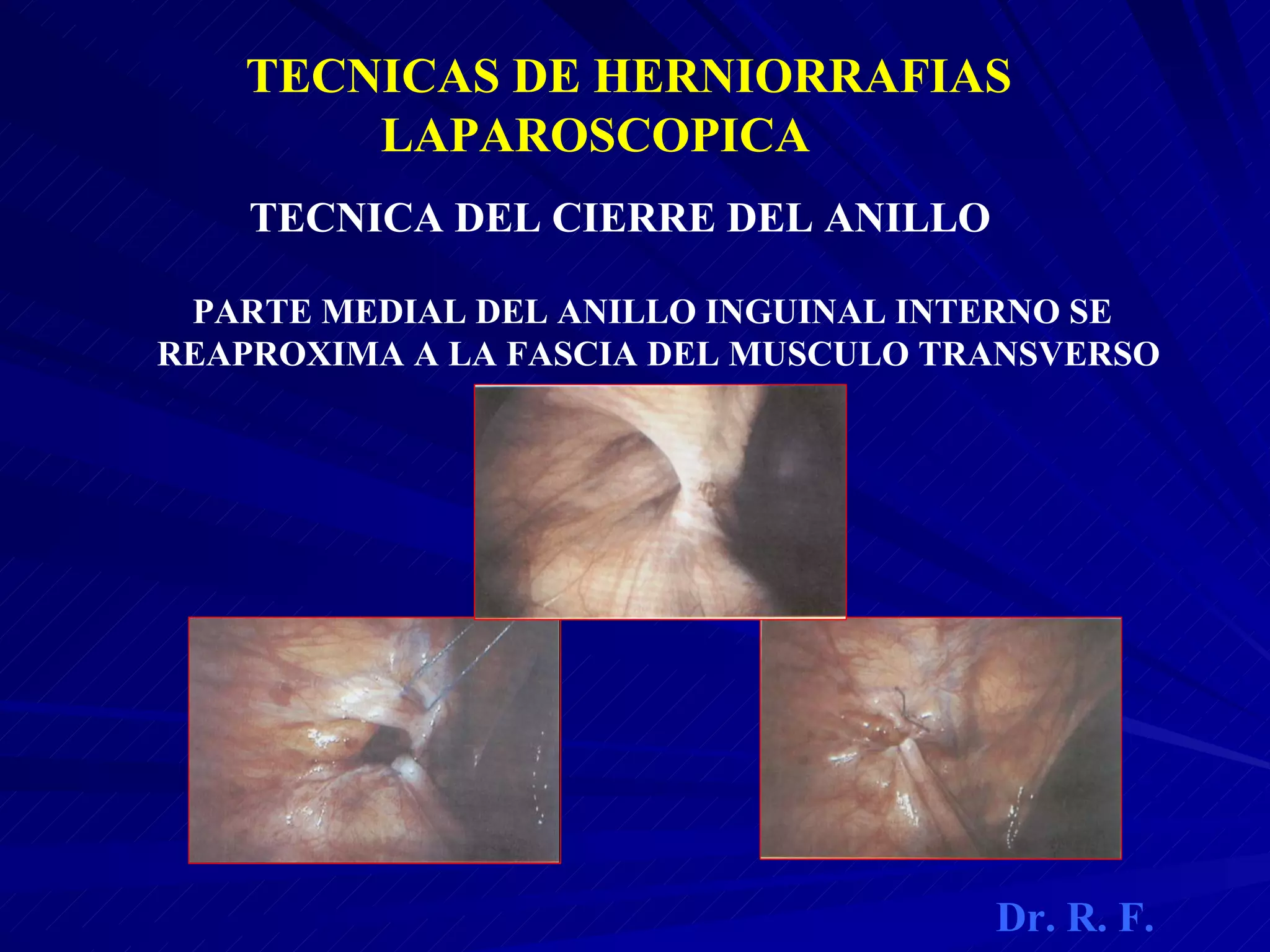 anatomia-laparoscopica-de-hernias-pdf