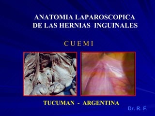 TUCUMAN - ARGENTINA
ANATOMIA LAPAROSCOPICA
DE LAS HERNIAS INGUINALES
C U E M I
Dr. R. F.
 
