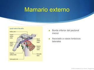 Mamario externo
S Borde inferior del pectoral
menor
S Asociado a vasos torácicos
laterales
Enfermedades de la mama, Haggensen
 