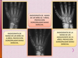 RADIOGRAFÍA DE
MANO EN UN NIÑO DE
4 AÑOS; PROYECCIÓN
DORSOPALMAR MANO
DERECHA.
RADIOGRAFÍA DE MANO
DE UN NIÑO SE 7 AÑOS;
PROYECCIÓN
DORSOPALMAR MANO
DERECHA.
RADIOGRAFÍA DE LA
MANO DE UN
ADOLESCENTE DE 15
AÑOS, PROYECCIÓN
DORSOPALMAR MANO
DERECHA.
 