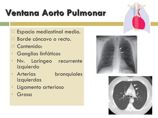 Ventana Aorto Pulmonar Espacio mediastinal medio. Borde cóncavo o recto. Contenido: Ganglios linfáticos Nv. Laríngeo recurrente izquierdo Arterias bronquiales izquierdas Ligamento arterioso Grasa 