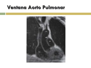 Ventana Aorto Pulmonar 