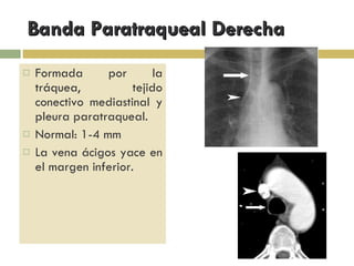 Banda Paratraqueal Derecha Formada por la tráquea, tejido conectivo mediastinal y pleura paratraqueal. Normal: 1-4 mm La vena ácigos yace en el margen inferior. 