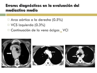 Errores diagnósticos en la evaluación del mediastino medio Arco aórtico a la derecha (0.5%) VCS izquierda (0.3%) Continuación de la vena ácigos  VCI 