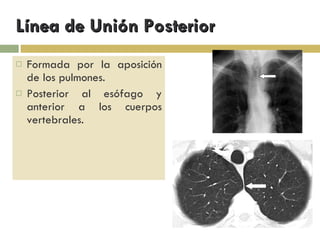 Línea de Unión Posterior Formada por la aposición de los pulmones. Posterior al esófago y anterior a los cuerpos vertebrales. 