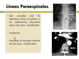 Líneas Paraespinales Son creadas por la interfase entre el pulmón y las reflexiones pleurales sobre los cpos. vertebrales Izquierda Paralela al margen lateral de los cpos. vertebrales 