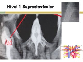 Nivel 1 Supraclavicular 