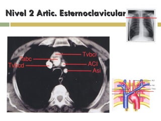 Nivel 2 Artic. Esternoclavicular 