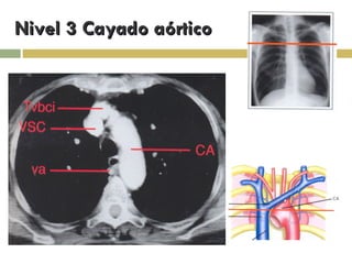 Nivel 3 Cayado aórtico 