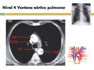 Nivel 4 Ventana aórtico pulmonar 