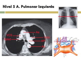 Nivel 5 A. Pulmonar Izquierda 