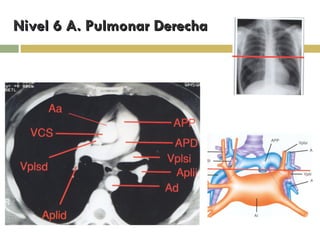 Nivel 6 A. Pulmonar Derecha 