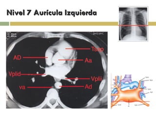 Nivel 7 Aurícula Izquierda 
