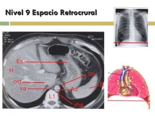 Nivel 9 Espacio Retrocrural  
