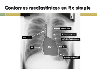 Contornos mediastínicos en Rx simple 