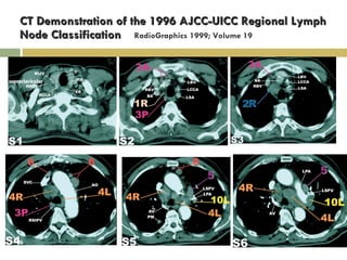 CT Demonstration of the 1996 AJCC-UICC Regional Lymph Node Classification  RadioGraphics 1999; Volume 19 